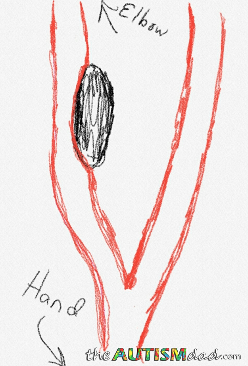 An update on the mass in Gavin's forearm