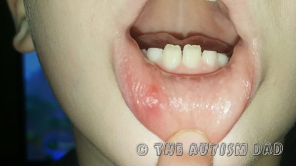 Emmett's fever flares may have returned