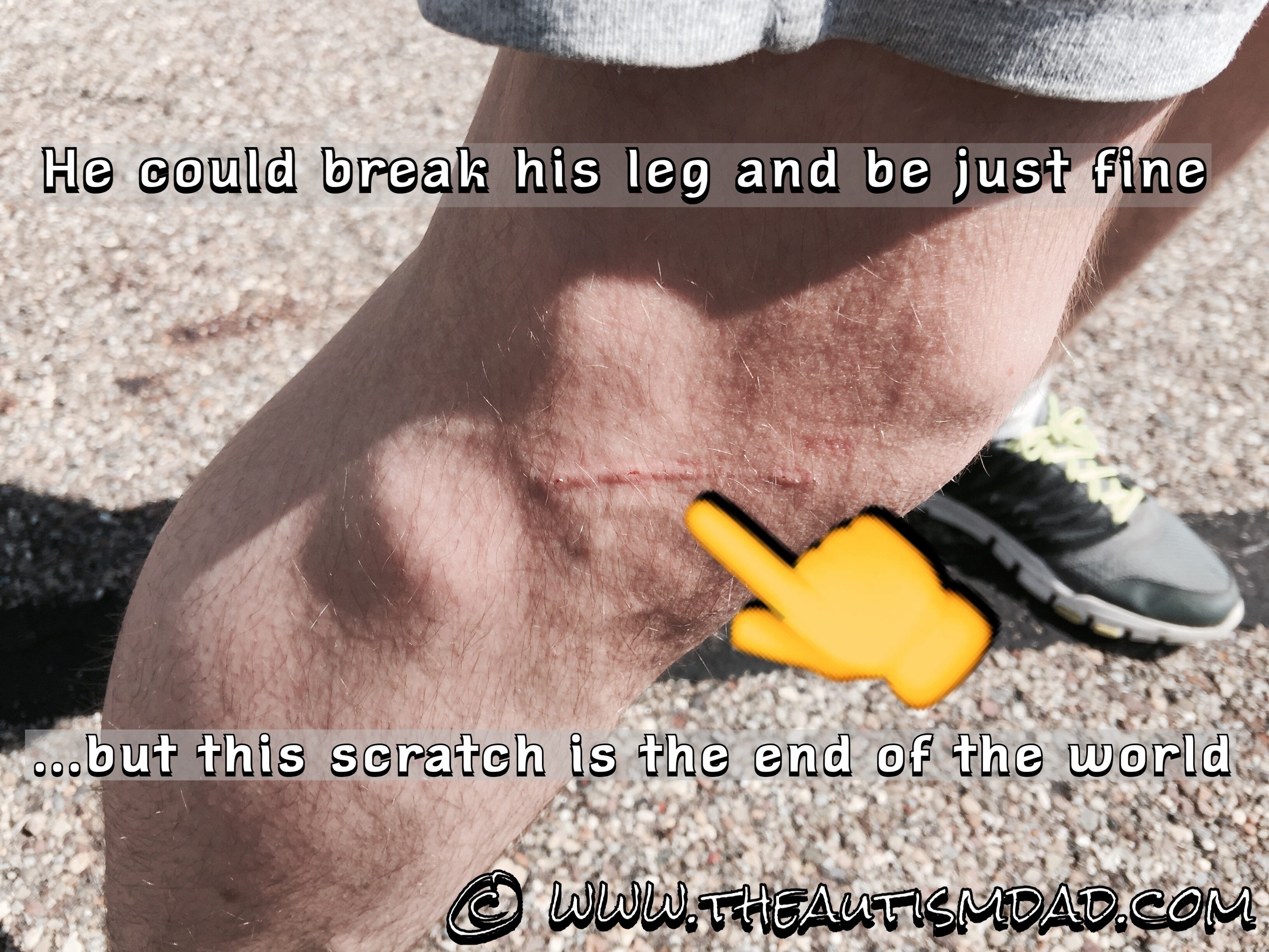 My son with #Autism has bizarre pain perception