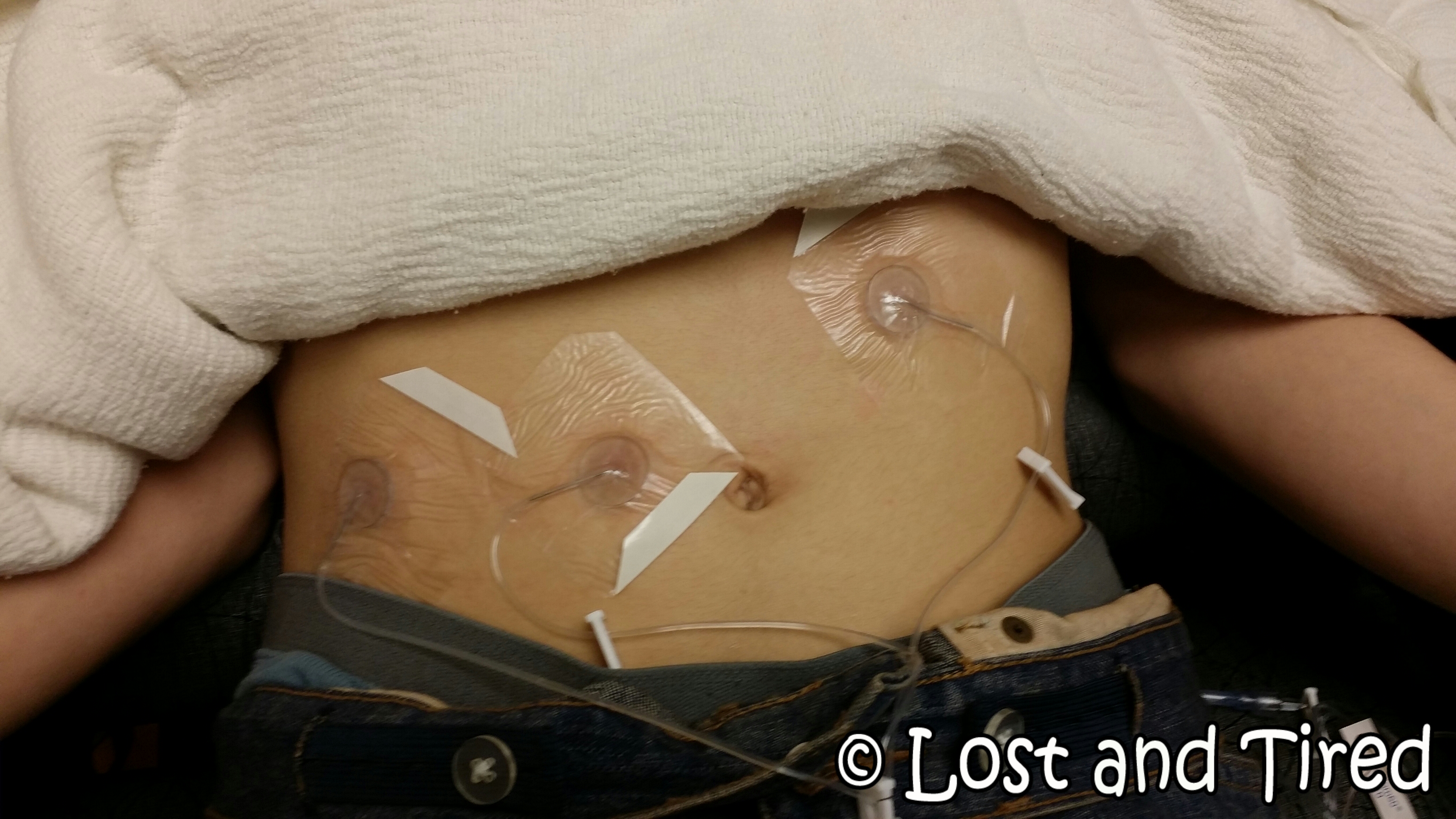 Subcutaneous IVIG - We're officially underway